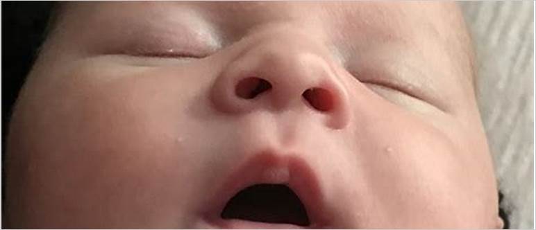 Newborn bubble on lip